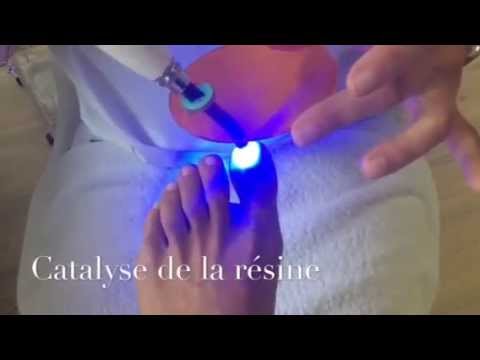Ongle gros orteil douloureux