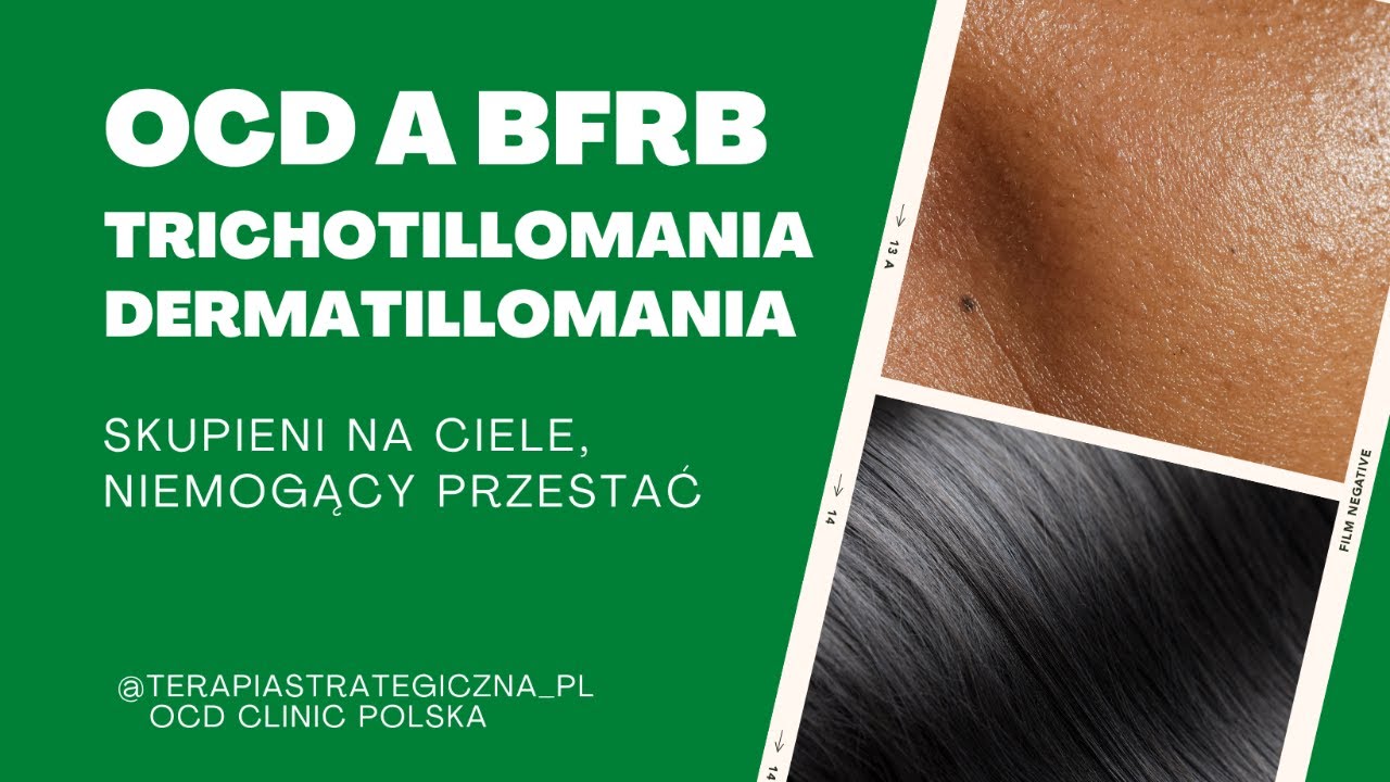 OCD a BFRB na przykładzie trichotillomanii i dermatillomanii