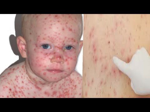 Cara Mengobati Campak yang Paling Ampuh dengan Obat Campak Alami