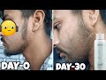 सिर्फ 1 महीने में दाढ़ी उगाए | mars minoxidil review | mars by ghc minoxidil review | mars beard