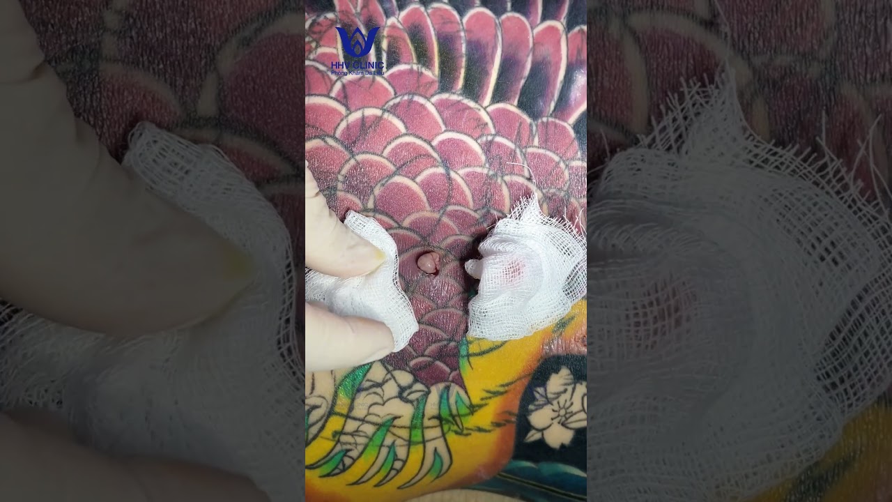 Nặn mụn áp xe ở Lưng.