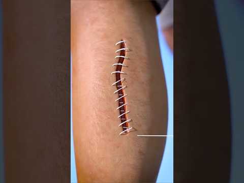 ده اللي بيحصل لجسمك لما بتخيط الجرح