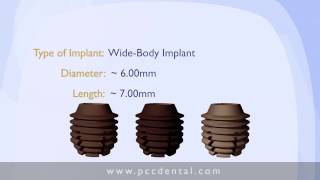 Ask Gordon:  What is a small-diameter implant?