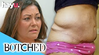 Woman Has Discharge Coming Out Of Belly Button After 'Tummy Tuck' | Botched