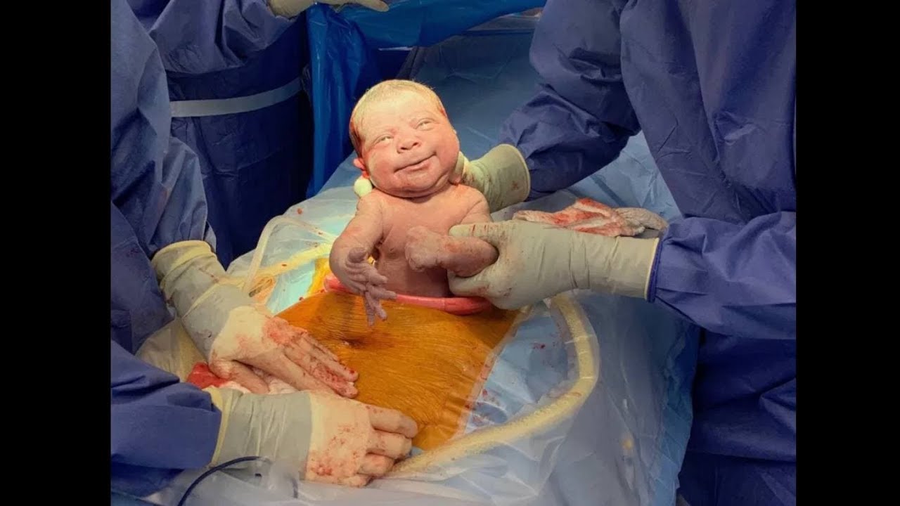 Cesarean Section