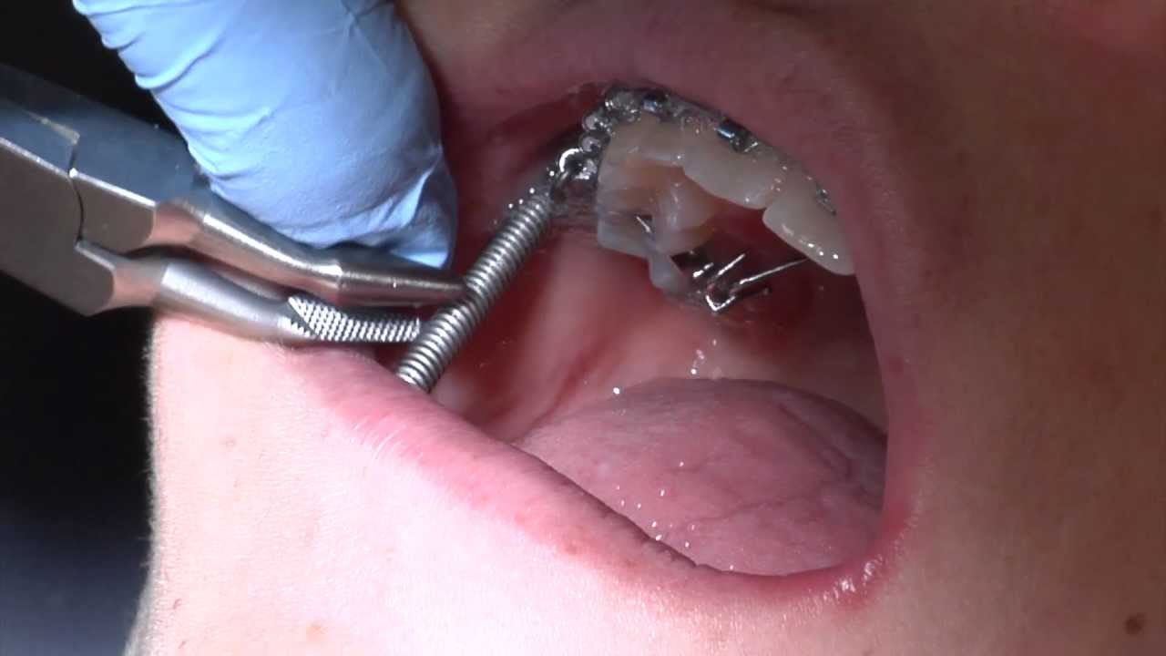 Forsus Appliance Insertion