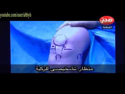 عملية منظار الركبة التشخيصى  Arthroscopy Knee