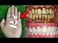 सिर्फ 2 मिनटों में गंदे पीले दांतो को मोती की तरह चमका देगा ये नुस्खा | White Teeth home remedy