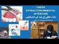 Stop! Do This After Tooth Extraction to Prevent Dry Socket and speed up recovery.