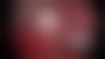 Right Lower Lobe Superior Segmentectomy for Metastatic Colorectal Cancer