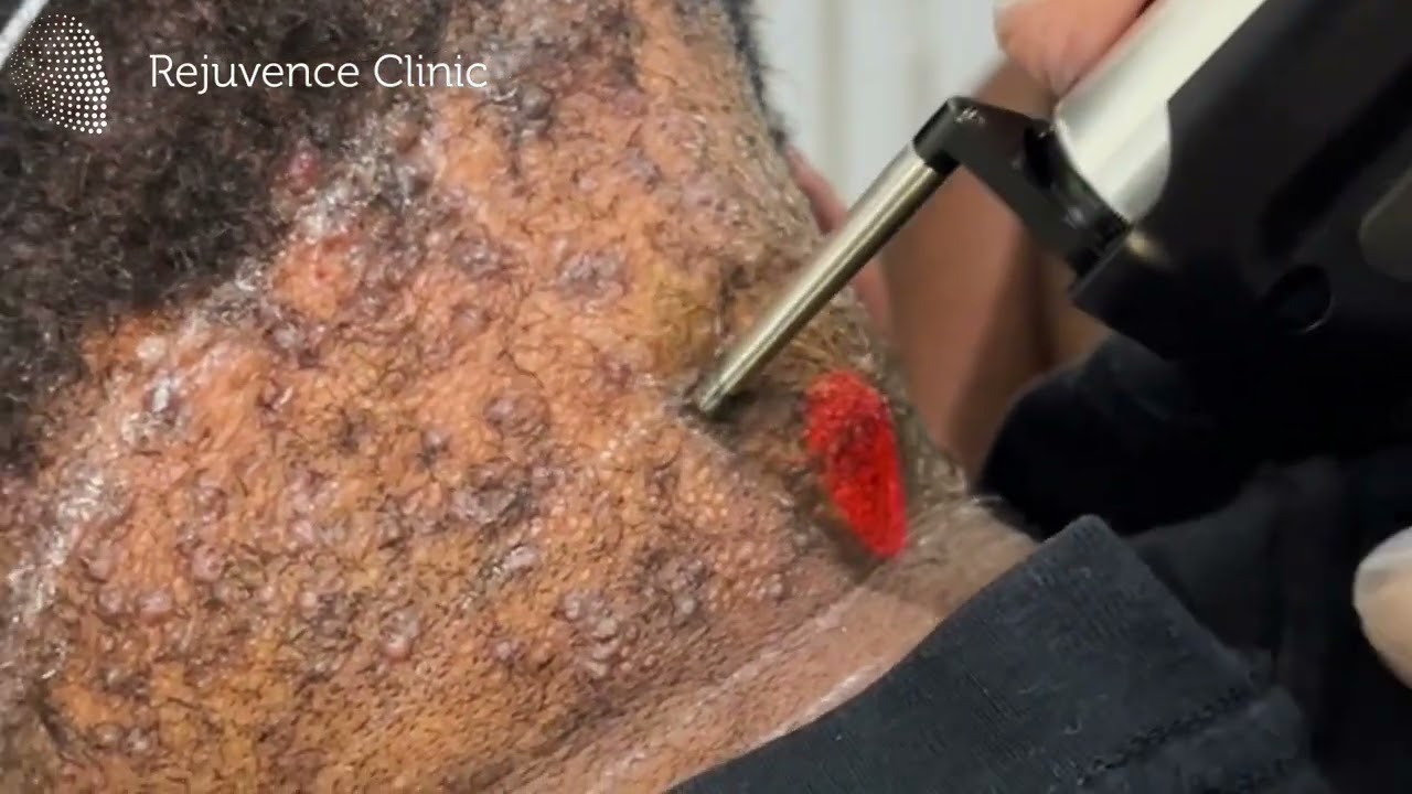 Laser treatments for Acne Keloidalis Nuchae