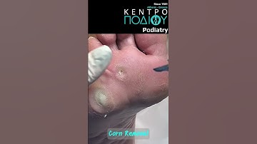 Corn Removal #calluses #footpain #κεντροποδιου #feet #foot #πόδια #callusremoval  #corn #corns