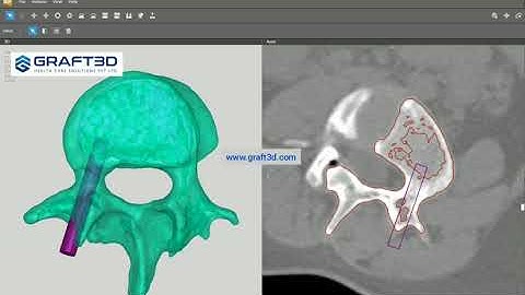 Virtual Planning for Spine surgery using D2P ( Dicom to Print ) Software.