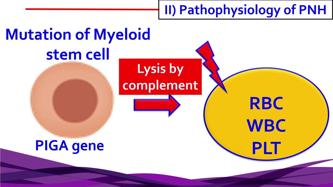 Lecture1 Paroxysmal nocturnal hemoglobinuria PNH