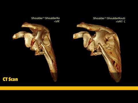 Glenoid&DistalClavicleFracture:ORIFHookPlate-ReconstructionPlateกระดูกสะบักและเบ้ากระดูกแตกDr.Bancha