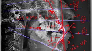 09- Dental Assessment ( Cephalometric analysis )