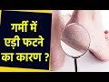 गर्मी में एड़ी फटने का कारण | Garmi Me Edi Fatne Ka Karan | Boldsky *Health