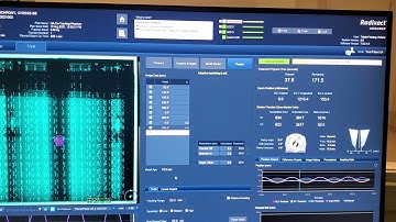 Radixact synchrony lung tumor in ArcCHECK by Dr. Roland Teboh