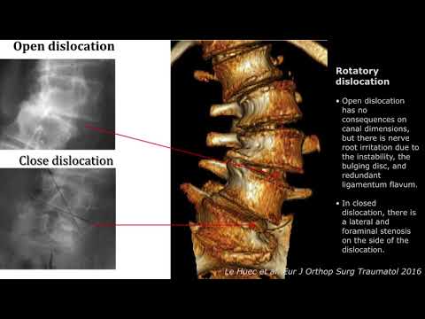 Wie werden coronale Aufnahmen der Skoliose beurteilt? Adulte spinale Deformitäten Part 2-2