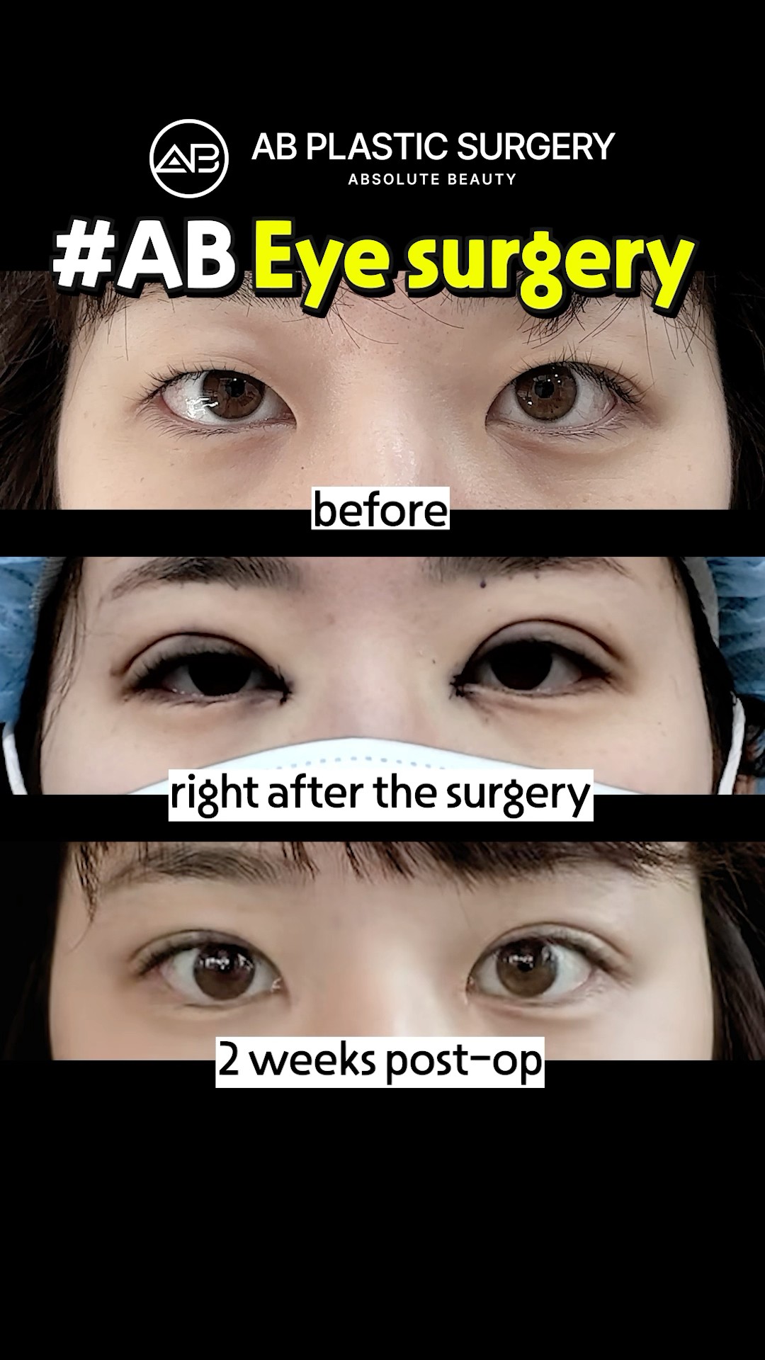 2 Weeks After Double Eyelid Surgery #koreanplasticsurgery