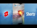 What Is Lumbar Lateral Stenosis? | Foraminal Stenosis #Shorts