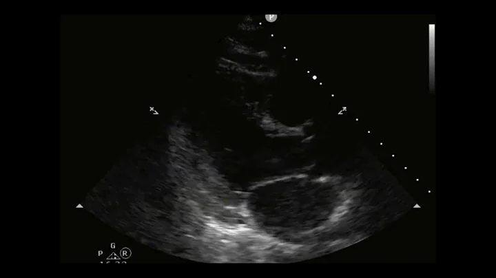 How to...Measure LV Fractional Shortening in 2D Mode