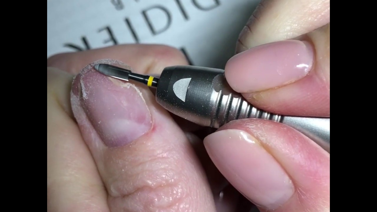 Nulūžusio nago ir oniholizės protezavimas Studios Didier polygeliu „On My Own“