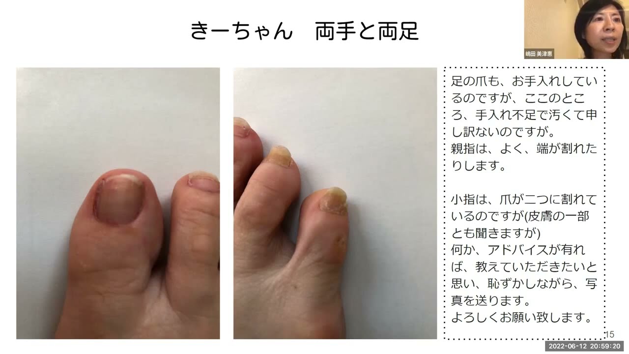 足の爪が割れて伸びない。小指の爪が2つに割れている：育爪診断_003
