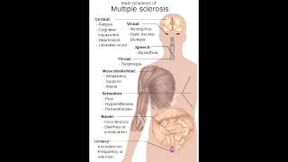 Multiple Sclerosis - Clinical Presentation