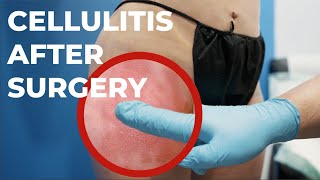 Can You Develop Cellulitis After a BBL?