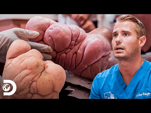 Dois casos incríveis de Síndrome de Proteus nos pés | Meus Pés Estão Me Matando | Discovery Brasil