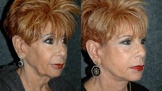 Facelift Surgery Technique by Dr Andrew Jacono #facelift