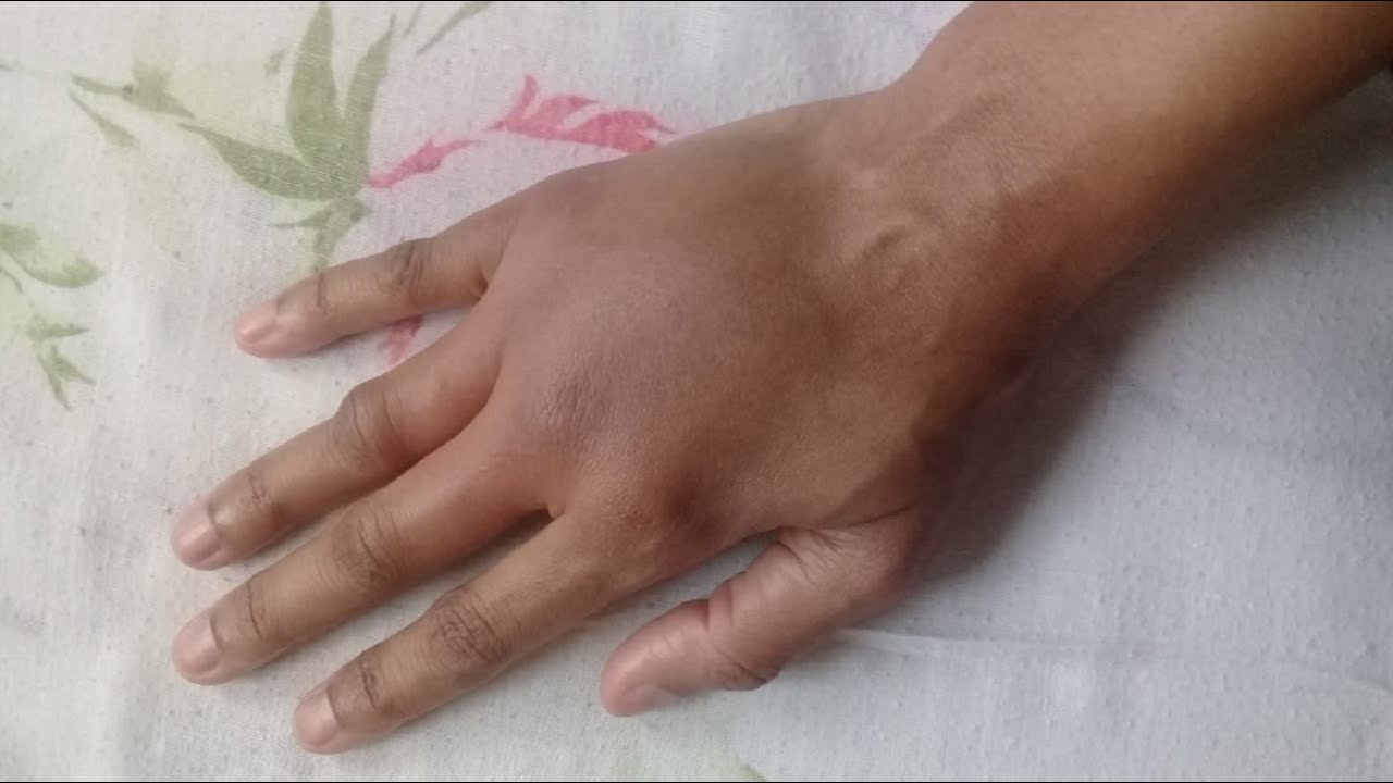 Como Curar Picada De Marimbondo Em 03 Horas YouTube