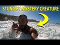 STUNG BY A MYSTEROUS CREATURE IN THE OCEAN