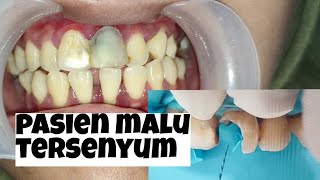 Download Lagu MEMBUAT PASIEN KEMBALI TERSENYUM!!! LUBANG BESAR DIGIGI DEPAN MP3