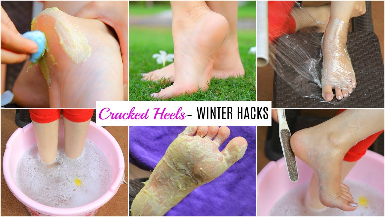 8 remedies for cracked heels and what causes them | GoodtoKnow