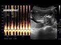 An anencephaly basic ultrasound informational