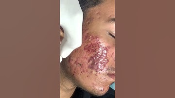 Thumbnail of Black Peel Treatment For Acne | chemical peel for acne | acne treatment | Skinaa Clinic #shorts