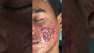 Black Peel Treatment For Acne | chemical peel for acne | acne treatment | Skinaa Clinic shorts