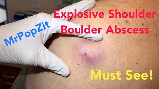 Explosive shoulder boulder abscess. You gotta see it to believe how much comes out of this pocket!