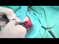 Transpalpebral enucleation in the dog