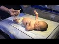 Newborn Baby With Constipation Glycerin Suppository For Stool Passage 
