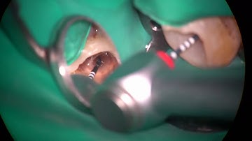 18644 bypassing a non visible ledge