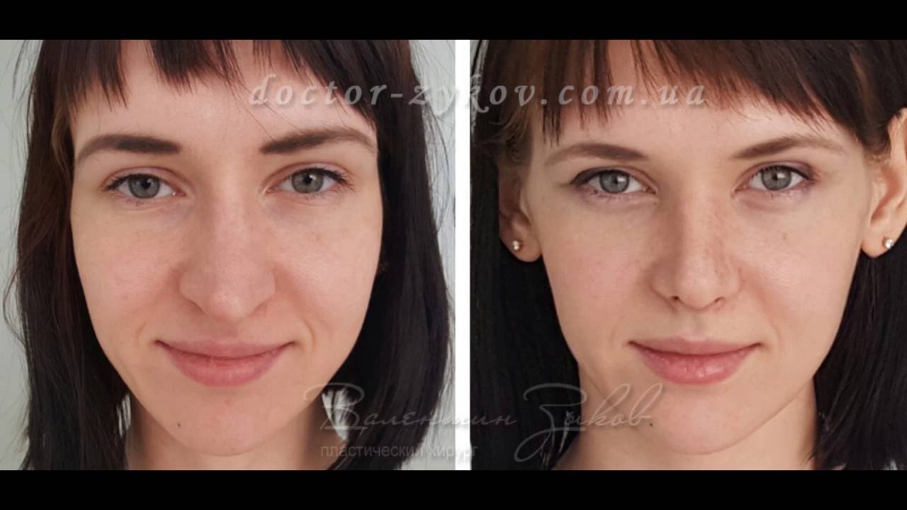 Открытая ринопластика. 10-й день - YouTube