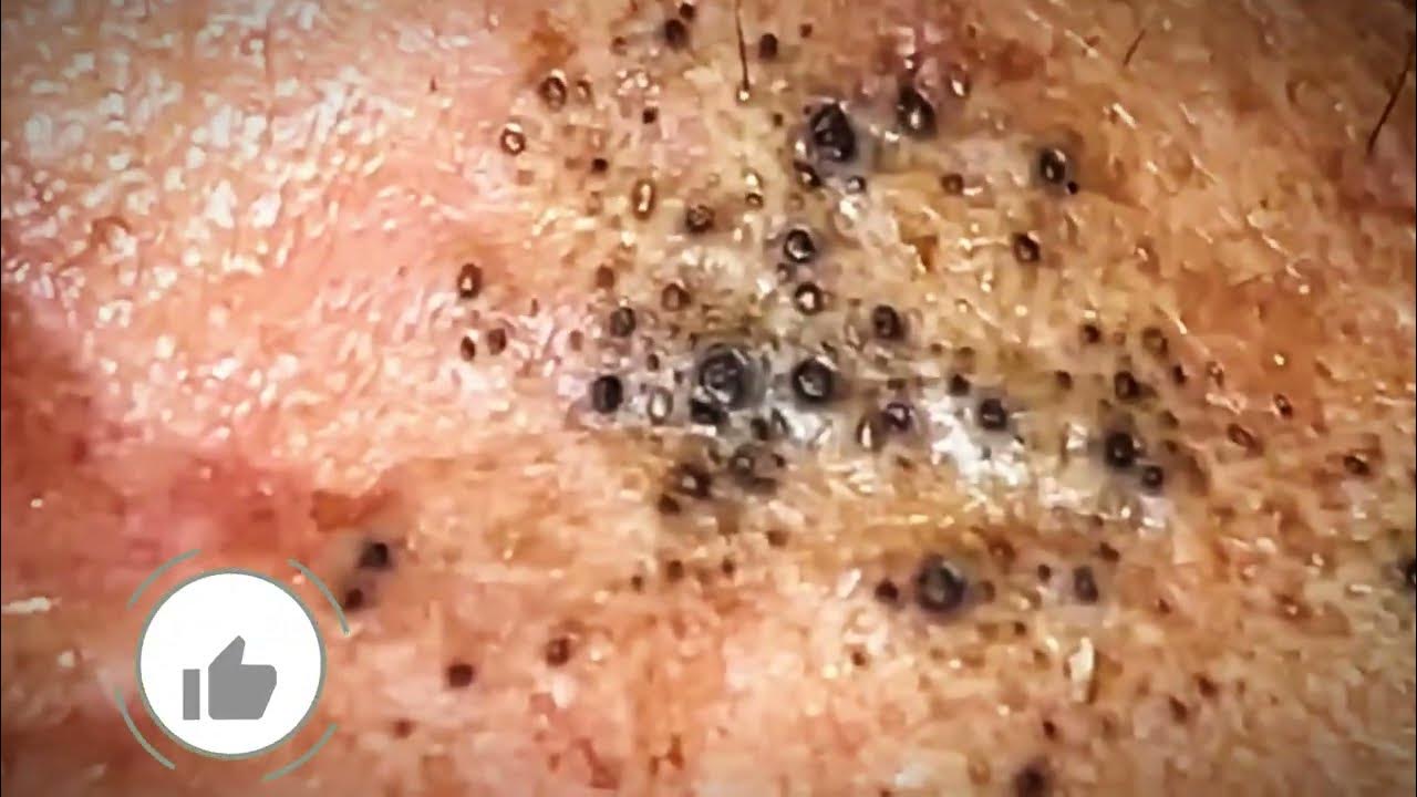 Most Satisfying CloseUp Blackhead Removal 2024 YouTube