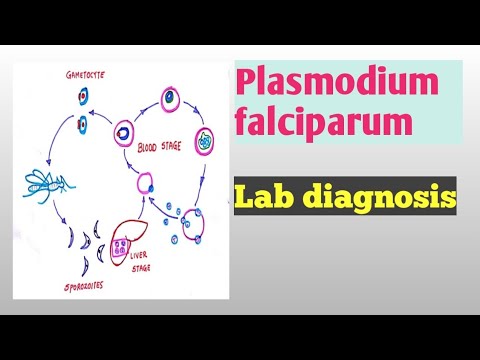 Wideo: CD14 Hi CD16 + Monocyty Fagocytozowe Opsonizowane Erytrocyty Zakażone Plasmodium Falciparum Skuteczniej Niż Inne Podgrupy Monocytów I Wymagają Do Tego CD16 I Dopełniacza