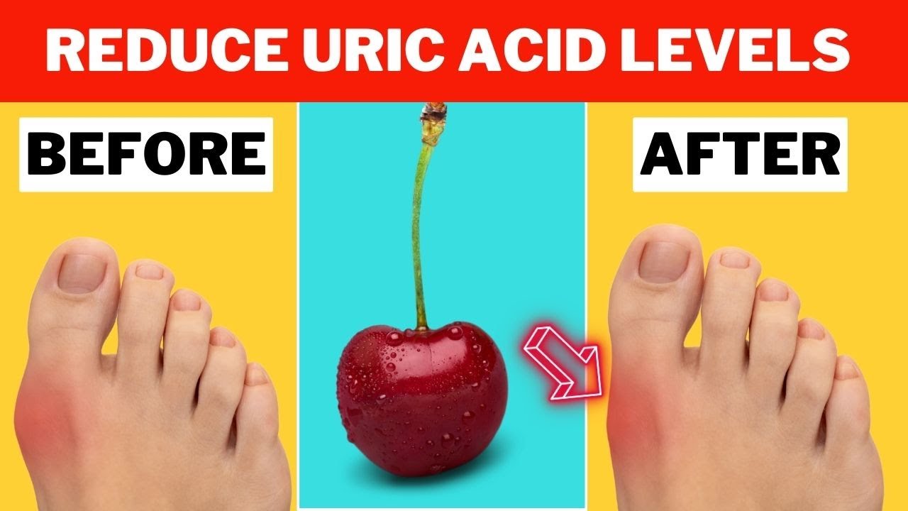 Lower Your Uric Acid Levels FAST with these 10 Foods! YouTube