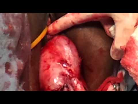 Huge Cervical Fibromatous Polyp Dr Abdul Vahab