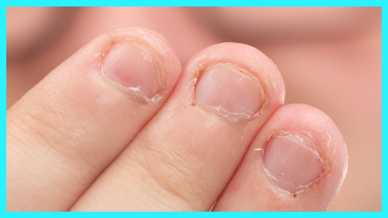 How To Stop Biting Your Nails