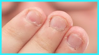 Fix Bitten Nails and Avoid Allergies with My Hack! screenshot 4